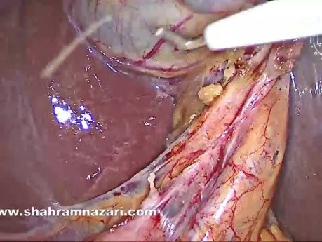 Ciekawostka anatomiczna: gdy zrosty nadają pęcherzykowi żółciowemu nieoczekiwany kształt