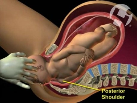Poród - dystocja barkowa