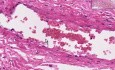 Adhezja - histopatologia - płuco, opłucna