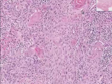 Rak płaskonabłonkowy - Histopatologia penisa