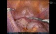 Endometrioza moczowodu