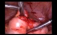 Migracja wkładki wewnątrzmacicznej do okrężnicy esowatej - leczenie laparoskopowe