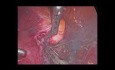 Laparoskopowa histerektomia macicy z mięśniakami