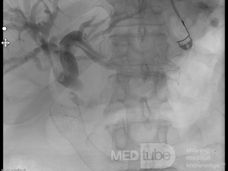 Endoskopowa hepaticogastrostomia pod kontrolą EUS [9/10]