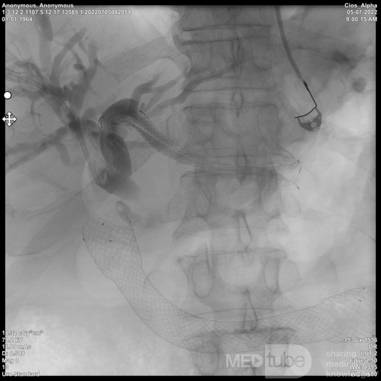 Endoskopowa hepaticogastrostomia pod kontrolą EUS [9/10]