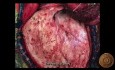 Pterion