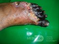 Martwica palców stopy