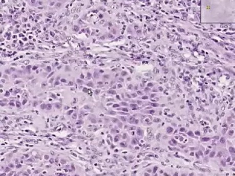 Rak kolczystokomórkowy - histopatologia skóry