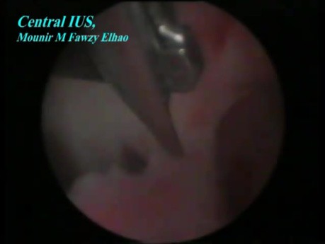 Centralne zrosty wewnątrzmaciczne po cięciu cesarskim - leczenie laparoskopowe