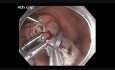 Klonoskopia: zamykanie olbrzymiego ubytku po endoskopowej resekcji śluzówkowej
