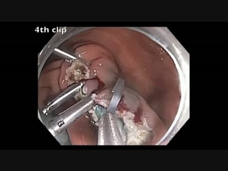 Klonoskopia: zamykanie olbrzymiego ubytku po endoskopowej resekcji śluzówkowej