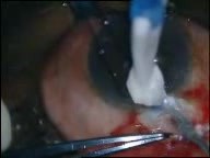 Operacja jaskry - trabekulektomia