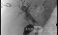 Endoskopowa choledochoduodenostomia pod kontrolą EUS [7/7]