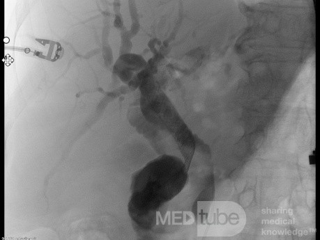 Endoskopowa choledochoduodenostomia pod kontrolą EUS [7/7]