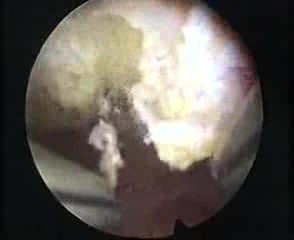 Polip endometrium - nowa technika resekcji 