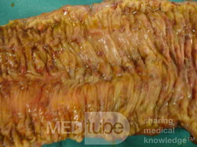 Toxic Dilatation of the Colon Superimposed pseudomembranous colitis involving the right colon (16 of 17)