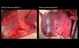 Resekcja chirurgiczna prawej, tylnej części wątroby z resekcją prawej żyły wątrobowej z powodu przerzutów raka okrężnicy - prezentacja przypadku