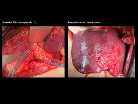 Resekcja chirurgiczna prawej, tylnej części wątroby z resekcją prawej żyły wątrobowej z powodu przerzutów raka okrężnicy - prezentacja przypadku