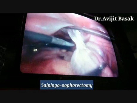 Chirurgia laparoskopowa skrętu torbieli jajnika ze ścisłymi zrostami