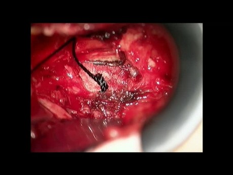 Operacja kręgosłupa szyjnego z dojścia grzbietowego metodą Frykholma