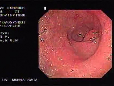 Nadżerkowe zapalenie błony śluzowej żołądka w części odźwiernikowej