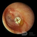 Śluzowe zapalenie ucha środkowego - drenaż przez rurkę wentylacyjną