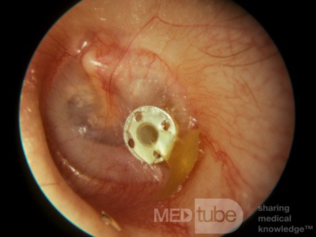 Śluzowe zapalenie ucha środkowego - drenaż przez rurkę wentylacyjną