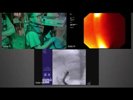 Przezjelitowe ECPW pod kontrolą EUS (Endoscopic Ultrasound-Directed Transenteric ERCP-EDEE)