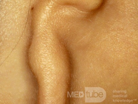 Mikrotia ucha prawego