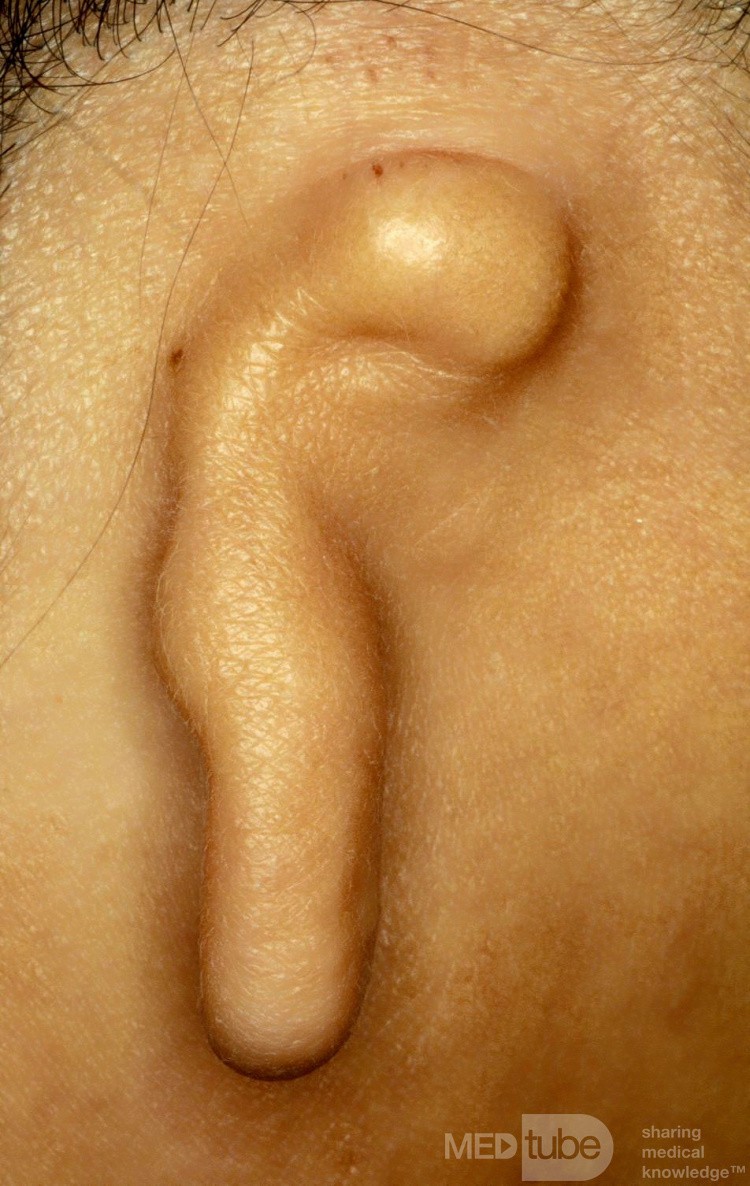 Mikrotia ucha prawego