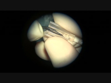 An Artificial Calcificated Lens Removal, Without Intact the Capsula 5 Years After it's Implantation