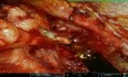 Voie Sous-Claviculaire Robotisée : Dissection Cervicale Mini-Invasive dans les Cancers de la Tête et du Cou