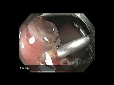 Kolonoskopia: zamykanie ubytków po endoskopowej resekcji śluzówkowej 4