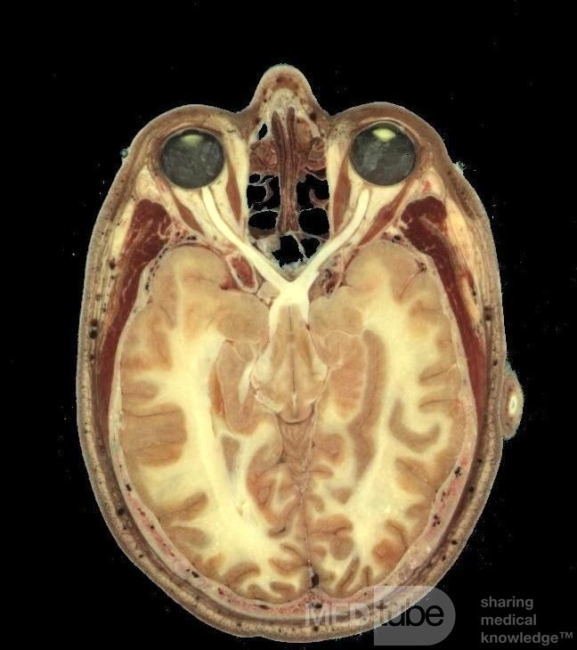 Anatomiczny stosunek między zatokami sitowymi a oczodołami