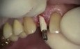 Natychmiastowa implantacja - Tymczasowy ząb #7
