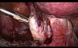 Usunięcie macicy z przydatkami - rak trzonu G2 FIGO III