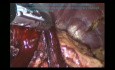 Laparoskopowa radykalna gatrektomia D2 z powodu raka żołądka 