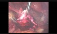 Torbielakogruczolak jajnika- laparoskopowe usunięcie guza jajnika