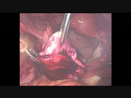 Torbielakogruczolak jajnika- laparoskopowe usunięcie guza jajnika