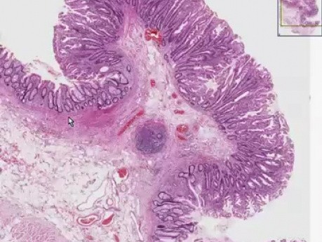 Polip hiperplastyczny - histopatologia - okrężnica