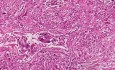 Przerzutowy mięsak gładkokomórkowy - histopatologia - płuco