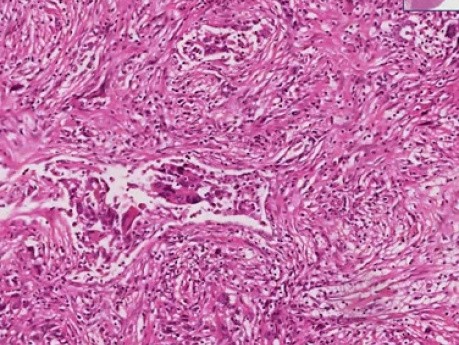 Przerzutowy mięsak gładkokomórkowy - histopatologia - płuco