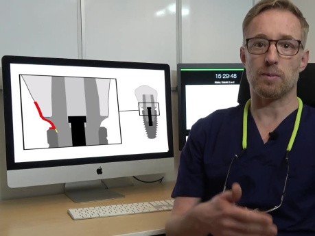 Kompleks nadgrzebieniowy implantu – International Journal of Prosthodontics