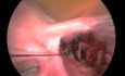 Podwiazanie tetnic macicznych przed zabiegiem laparoskopowej myomectomii