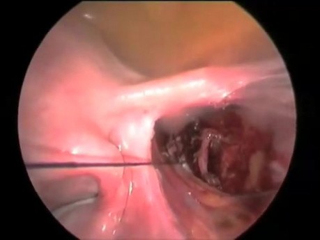 Podwiazanie tetnic macicznych przed zabiegiem laparoskopowej myomectomii