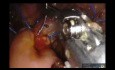 Robotyczna pankreatoduodenektomia z cholecystektomią z powodu litego pseudobrodawkowego nowotworu 