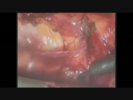 Laparoskopowa operacja przepukliny pępkowej