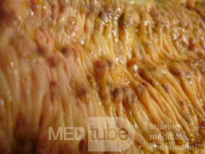 Toxic Dilatation of the Colon Superimposed pseudomembranous colitis involving the right colon (13 of 17)