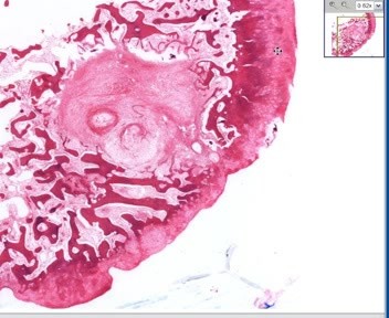 Oseoarthritis - torbiel podchrzęstna