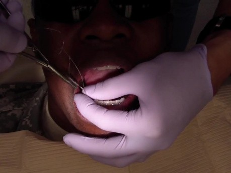 Przypadek Ortodontyczny #3 - Mezjalizacja Tylnego Segmentu Szczęki - Wykonanie Haczyka/Druta Kobayashi